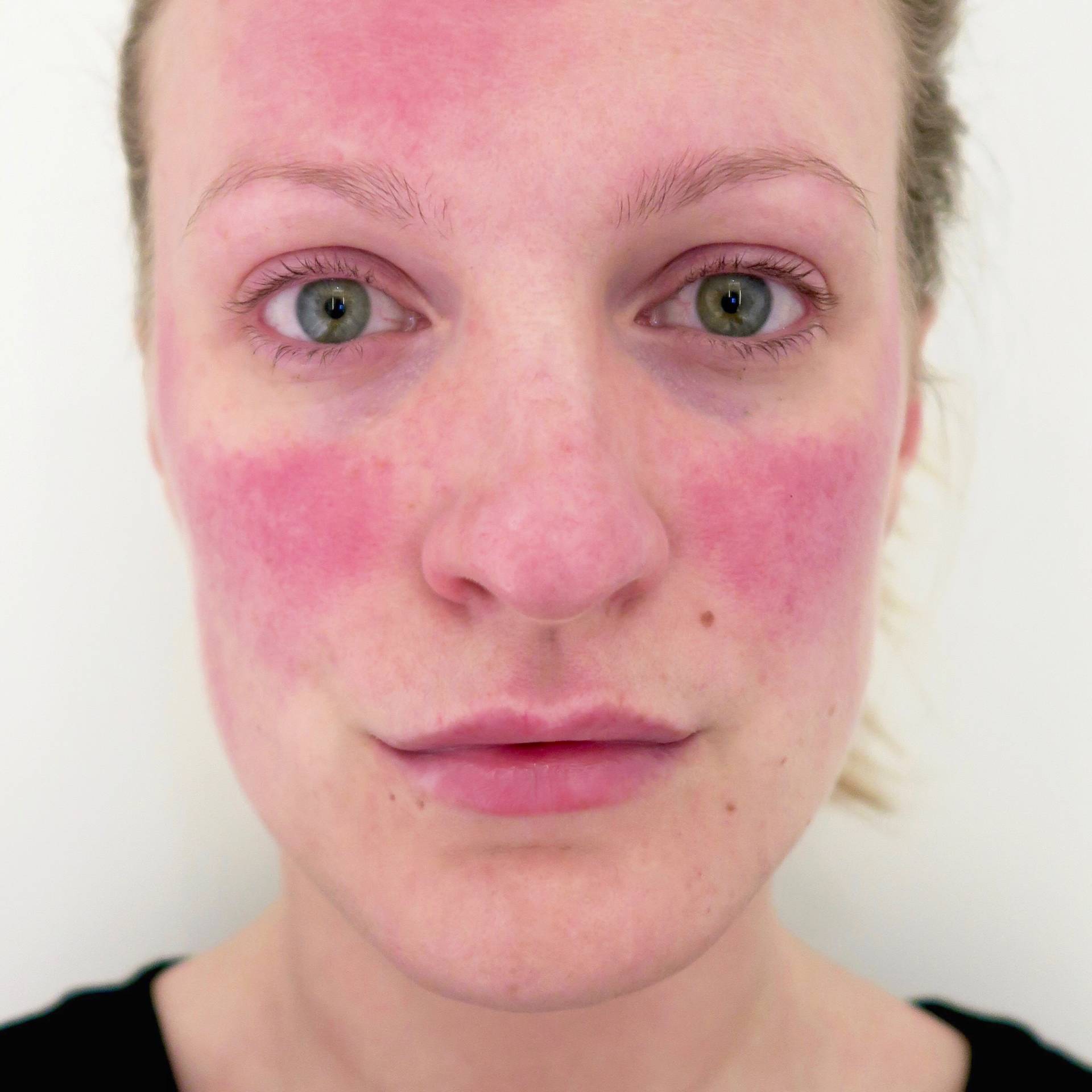 To Wear Or Not To Wear: why I wear make up to cover my rosacea