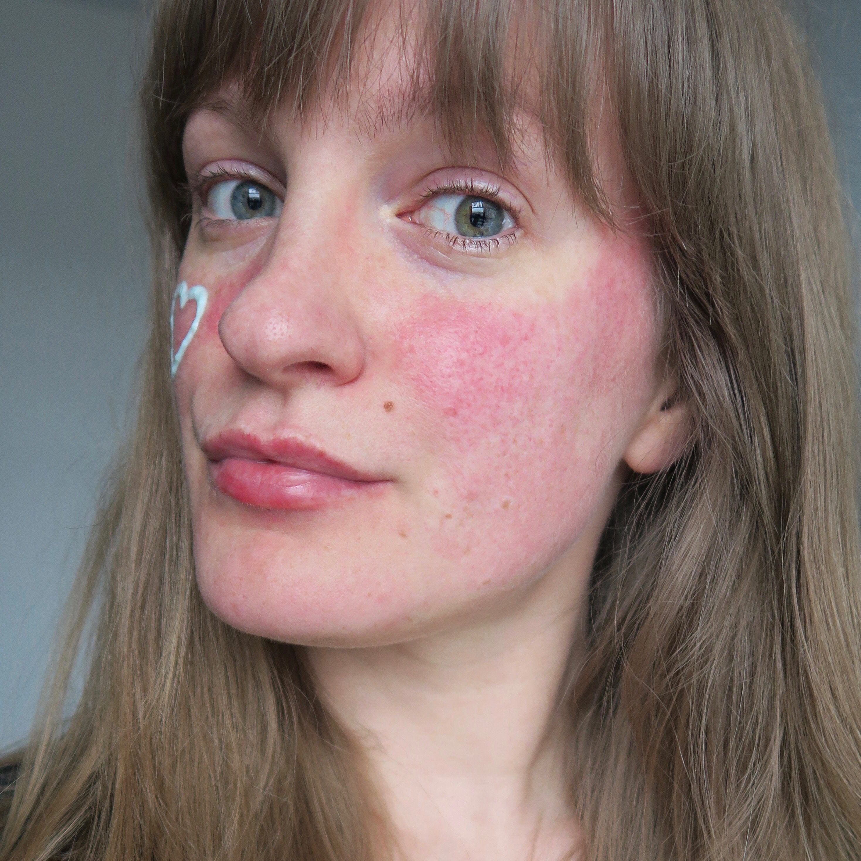 talontedlex-rosacea-flare-up-Nov-17 - Talonted Lex