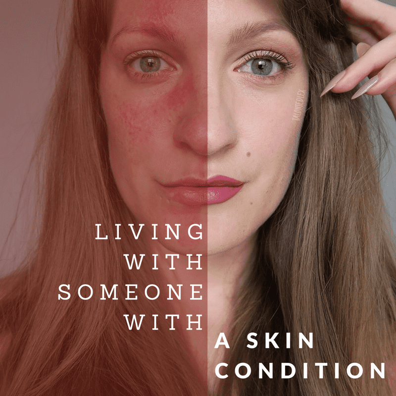 Living with someone with a skin condition: tips and advice about rosacea