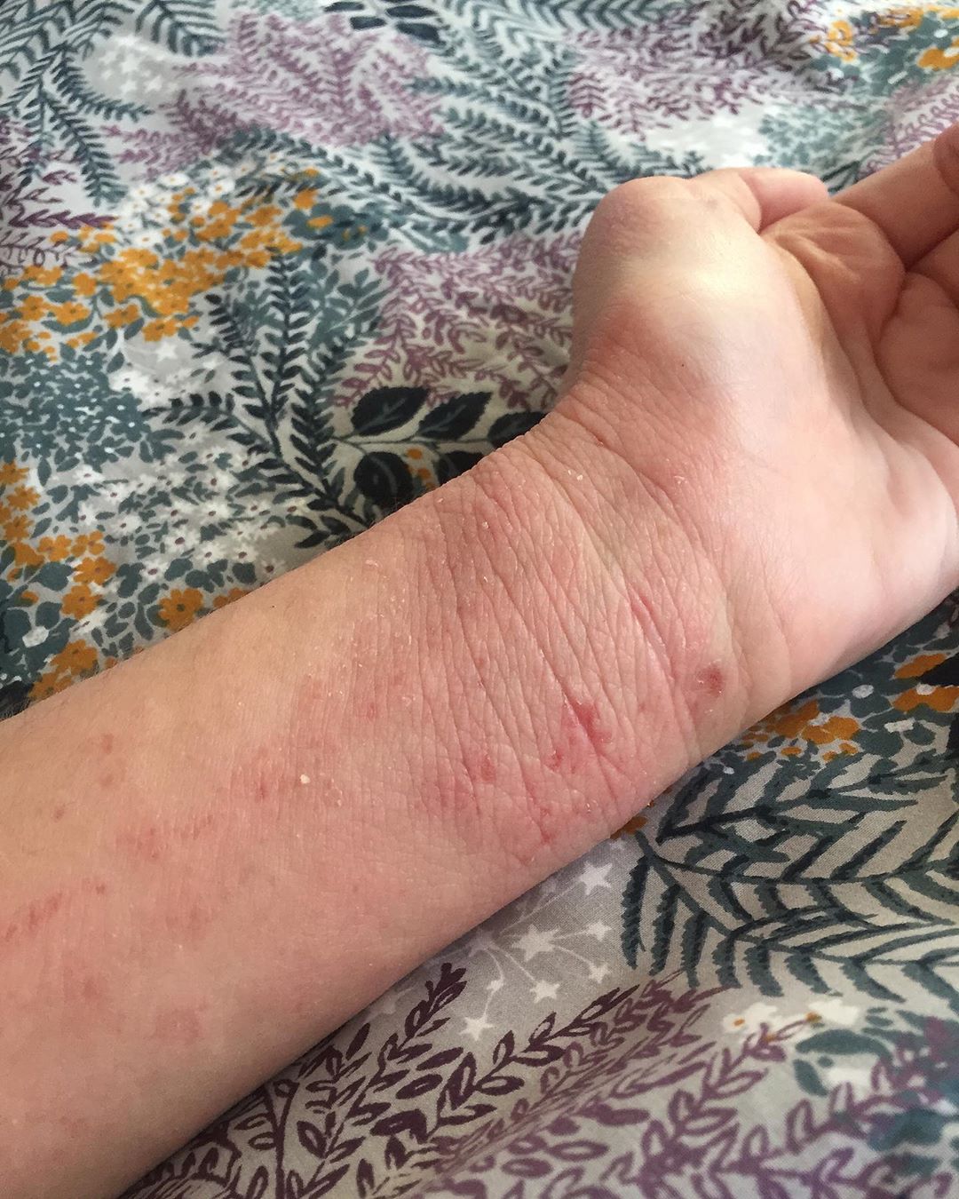 An interview about living with eczema. We chat skin positivity, eczema in the media, and the impact of skin conditions on mental health. Amara shares her eczema tips and advice. #talontedlex #eczematips #eczemaadvice