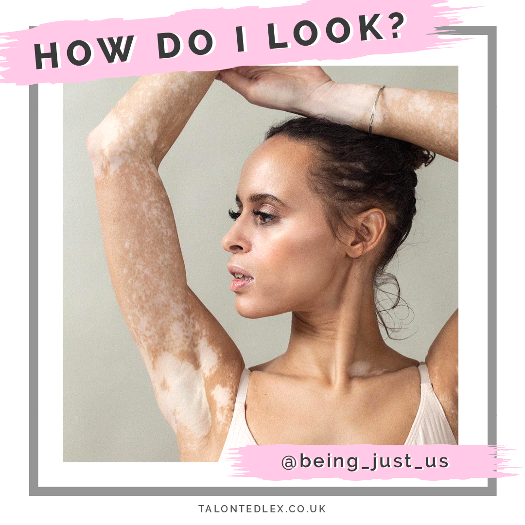 Repin and click to read my interview with Natalie (@being_just_us), Vitiligo and skin positivity advocate. She talks about growing up with Vitiligo, how representation has changed, and how she has grown to love her skin. #talontedlex #skinpositivity #vitiligo