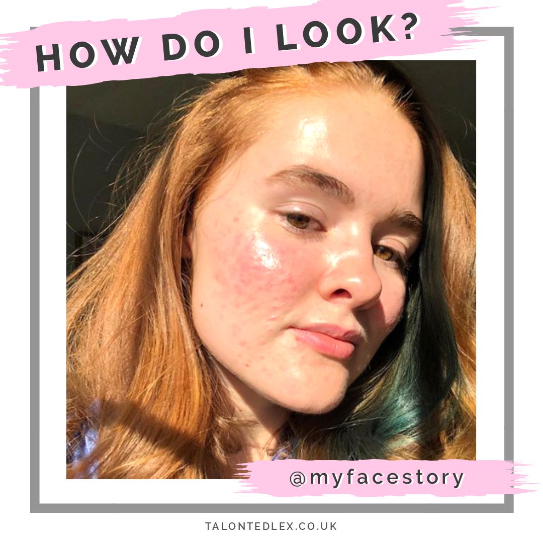 Read my interview with Kali (@myfacestory ), acne and skin positivity advocate. She talks about representing acne skin as part of the Sephora Squad, how she says positive, and why acne doesn't define her. #talontedlex #skinpositivity #acnepositivity