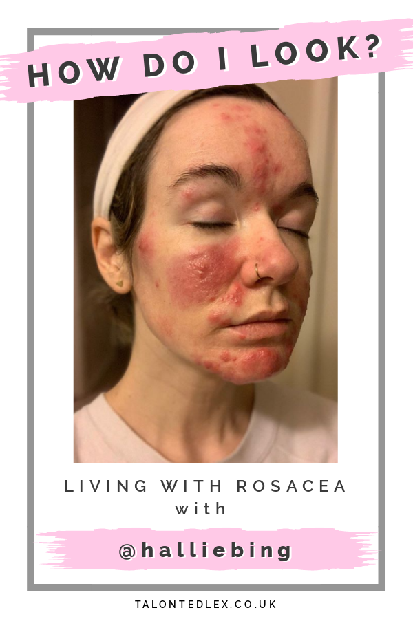 Read my interview with Hallie (@halliebing): skin positivity champion and rosacea sufferer. She shares her rosacea advice and advice on how to cope psychologically with a skin condition. #talontedlex #skinpositivity #rosaceatips