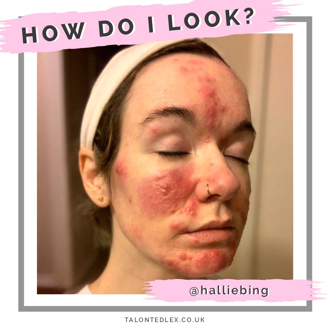 Read my interview with Hallie (@halliebing): skin positivity champion and rosacea sufferer. She shares her rosacea advice and advice on how to cope psychologically with a skin condition. #talontedlex #skinpositivity #rosaceatips